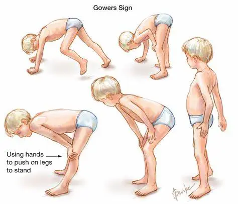 Shows a young boy exhibiting the Gowers Sign.